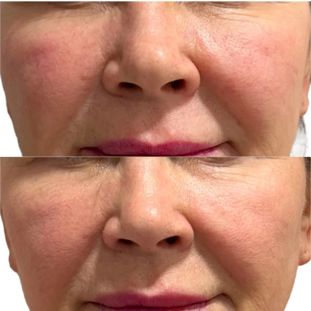 From flushed to flawless 🙌🏽
Rosacea, redness, and tiny veins can be frustrating, but Aerolase makes it simple. This client saw a major improvement in tone and clarity, all with a gentle laser that’s safe for every skin type (yes, even tanned or sensitive skin).

No downtime. No irritation. Just results that speak for themselves.

*Link in bio to book*

Visit our website at ministryofskin.ca and join our newsletter for exclusive promos!

#CalgarySkinClinic #CalgaryAesthetics #CalgaryMedispa #AerolaseCalgary 
#RosaceaTreatmentCalgary #VeinRemovalCalgary #YYCBeauty #YYCMedispa 
#YYCSkin #RednessRelief #LaserForRedness #ClearSkinCalgary

advanced skincare, medical aesthetics, skin treatment, skin tightening, non-invasive, skin rejuvenation, Calgary medispa, latest technology