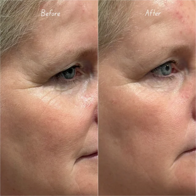 Morpheus8 + Exosomes 
After just one treatment, we’re already seeing tighter, smoother skin around the eyes.
Here’s what’s happening beneath the surface:
⚡️ Morpheus8 delivers RF energy deep into the dermis, triggering fibroblasts to produce fresh collagen and elastin.
💧 Exosomes amplify the process by accelerating cell repair, reducing downtime, and boosting the quality of the new tissue.

Together, they don’t just treat the skin — they retrain it to act younger.

Swipe to see details! 🙌🏽 

*Link in bio to book*

Visit our website at ministryofskin.ca and join our newsletter for exclusive promos!

#SkinGoals #CalgaryMedispa #AdvancedSkincare #NewTreatmentAlert #SkinClinicCalgary #MedicalAesthetics #SkinRejuvenation #NonInvasiveGlow #exosometherapy

advanced skincare, medical aesthetics, skin treatment, skin tightening, non-invasive, skin rejuvenation, Calgary medispa, latest technology